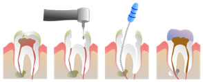 Root Canal